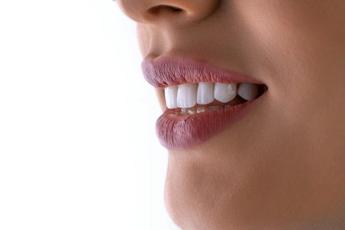 Lentes de contato dental